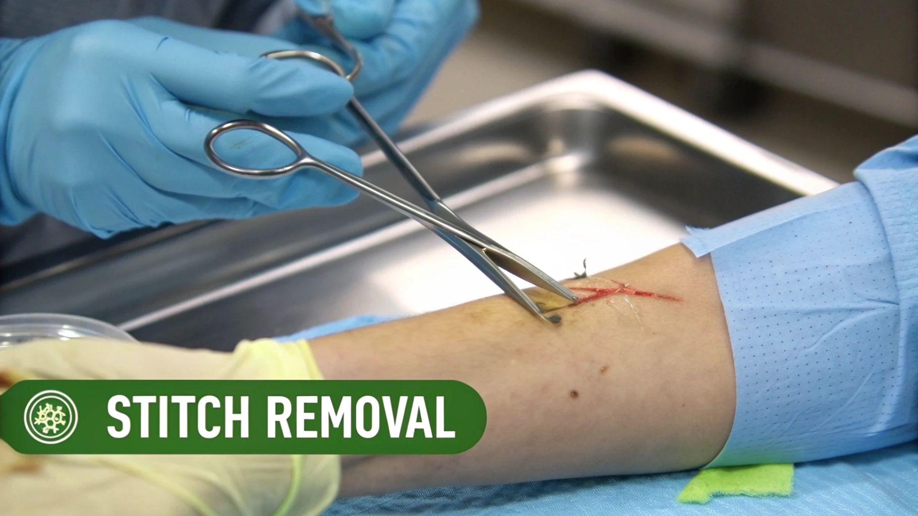 When Can Stitches Be Removed: A Guide to Proper Wound Healing - Carter's Walk-In + Urgent Care When Can Stitches Be Removed: A Guide to Proper Wound Healing - Carter's Walk-In + Urgent Care
