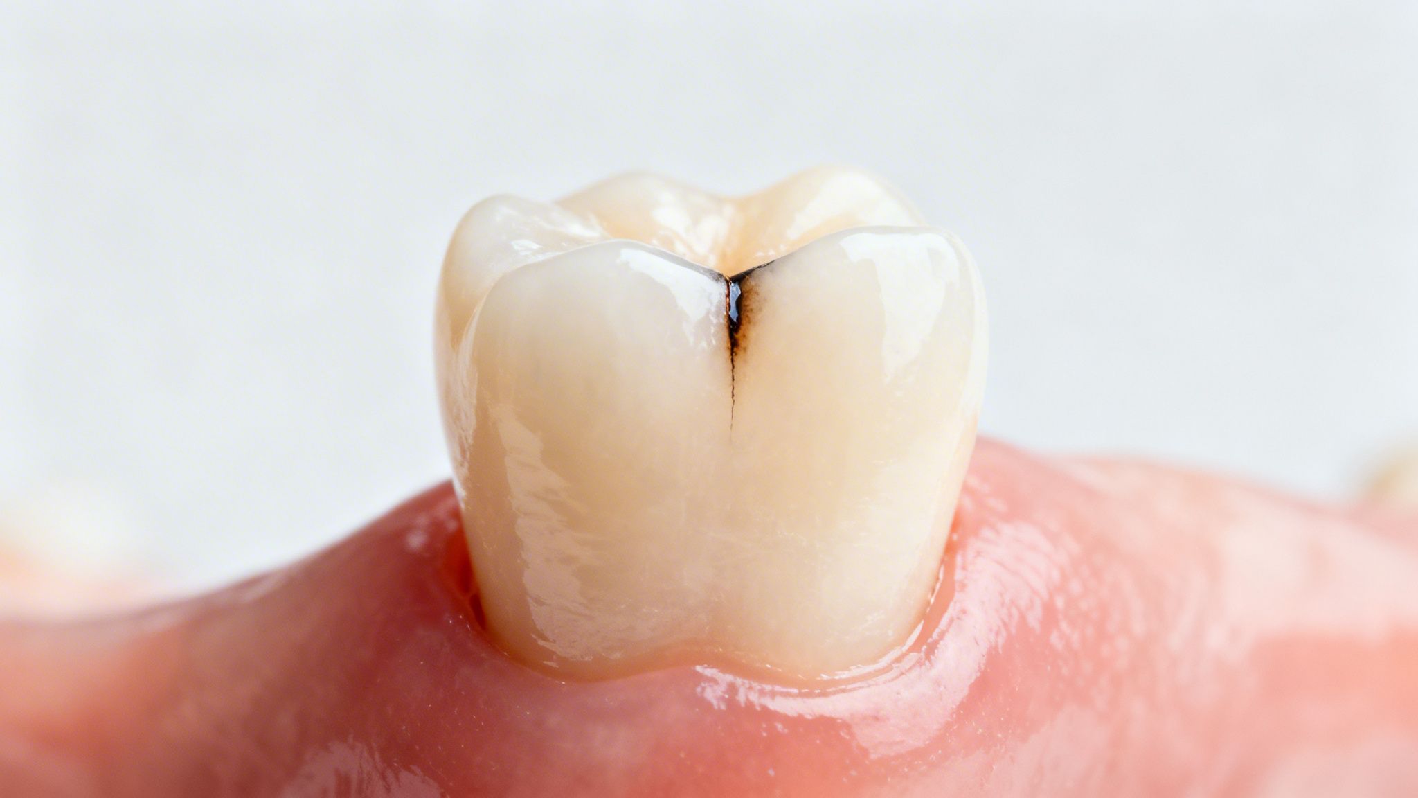 Close-up of a molar tooth showing a dark fissure or potential cavity on its biting surface.