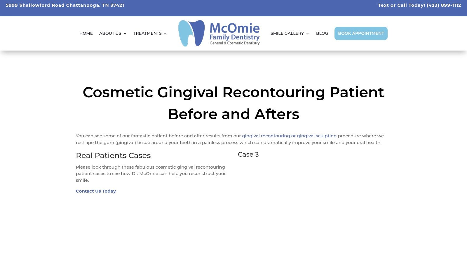 Charles E. Boren | Tooth Reshaping in Bellaire, TX: See the Before and After Difference A before and after image from McOmie Family Dentistry showcasing the results of cosmetic gingival recontouring to correct a gummy smile.