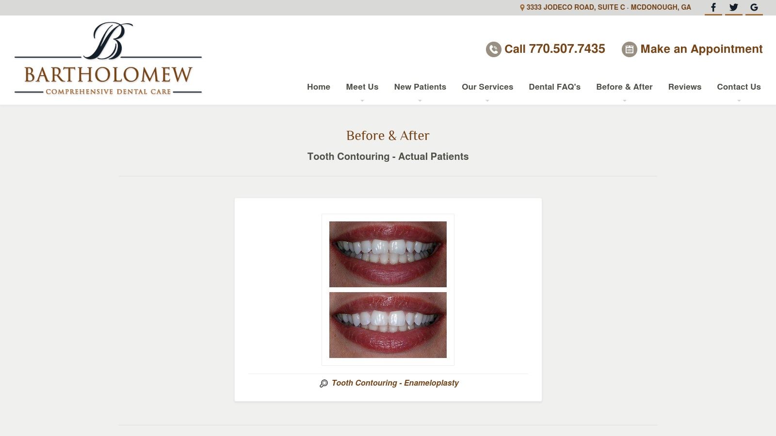 Charles E. Boren | Tooth Reshaping in Bellaire, TX: See the Before and After Difference Bartholomew Comprehensive Dental Care (McDonoughDentists) – Tooth Contouring (Enameloplasty)