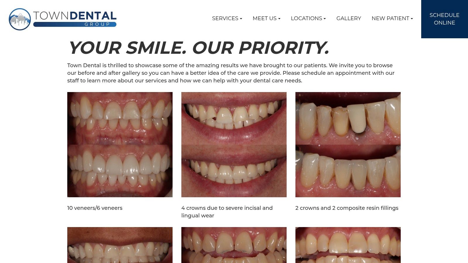 Charles E. Boren | Tooth Reshaping in Bellaire, TX: See the Before and After Difference A smile gallery from Town Dental showcasing various patient transformations, highlighting the effectiveness of combined cosmetic treatments like enameloplasty.