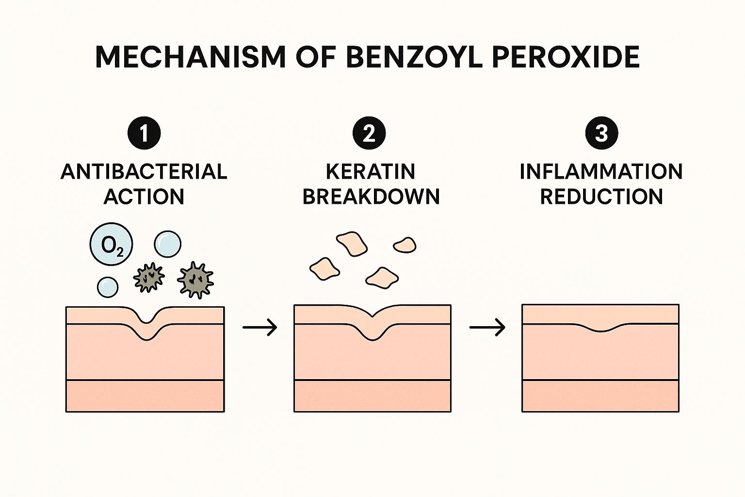 Infographic about what is benzoyl peroxide used for