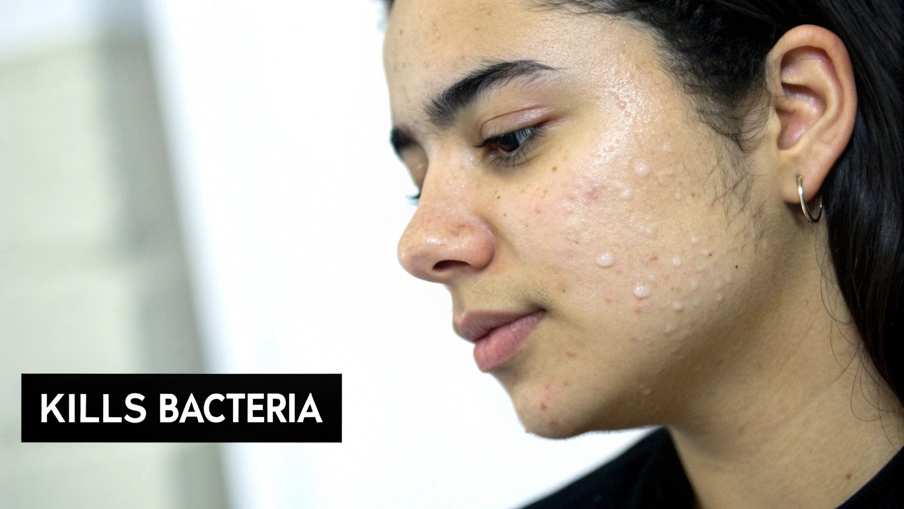 Illustration showing benzoyl peroxide molecules targeting and eliminating acne bacteria within a skin pore.