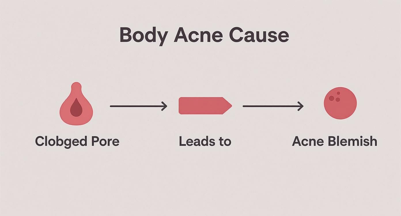 Diagram showing how a clogged pore leads to an acne blemish, illustrating body acne cause.