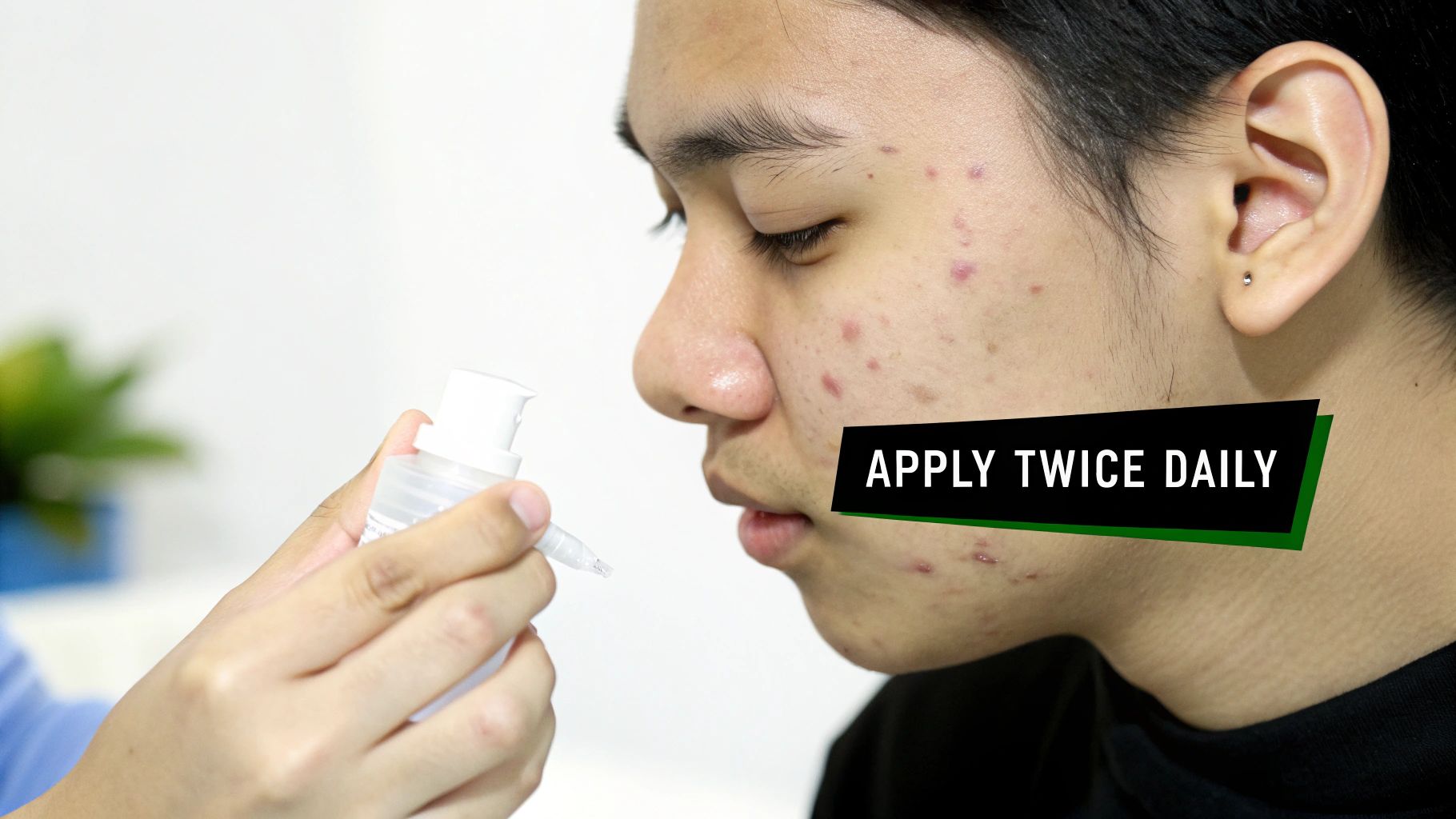 A person with acne-prone skin is shown applying a treatment gel, with text 'APPLY TWICE DAILY'.