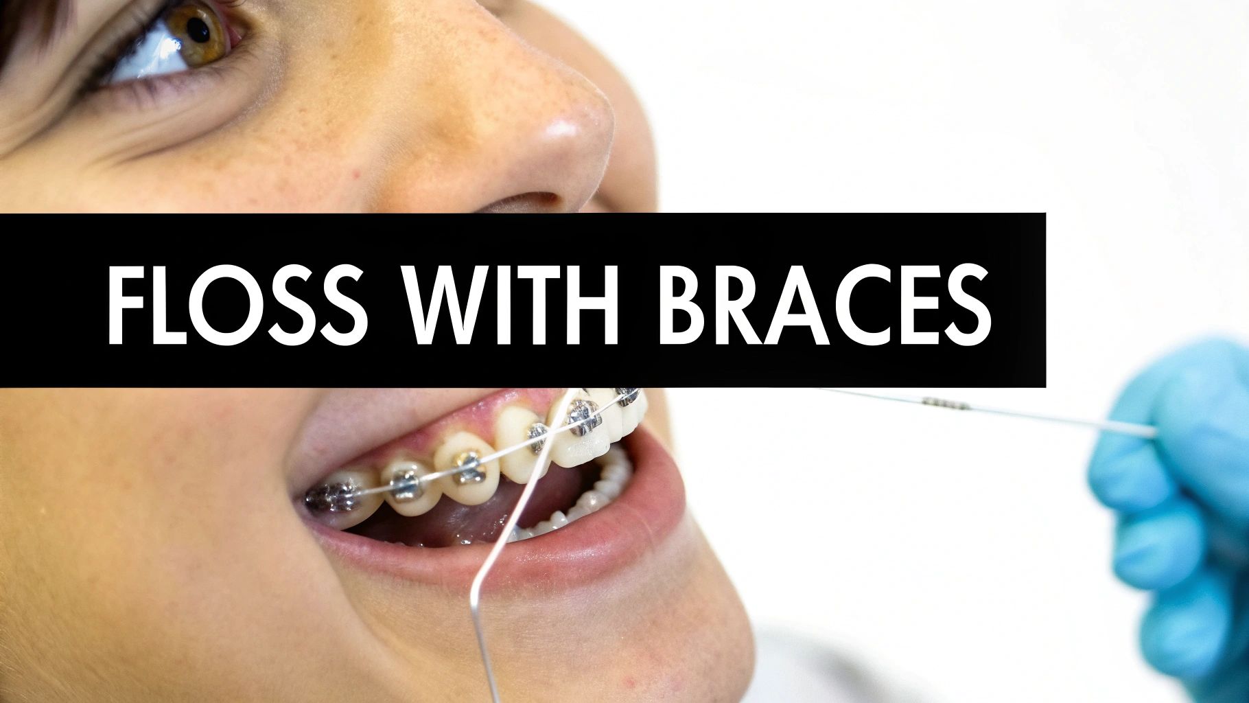 A close-up view of a person with dental braces flossing their teeth with assistance from a gloved hand.