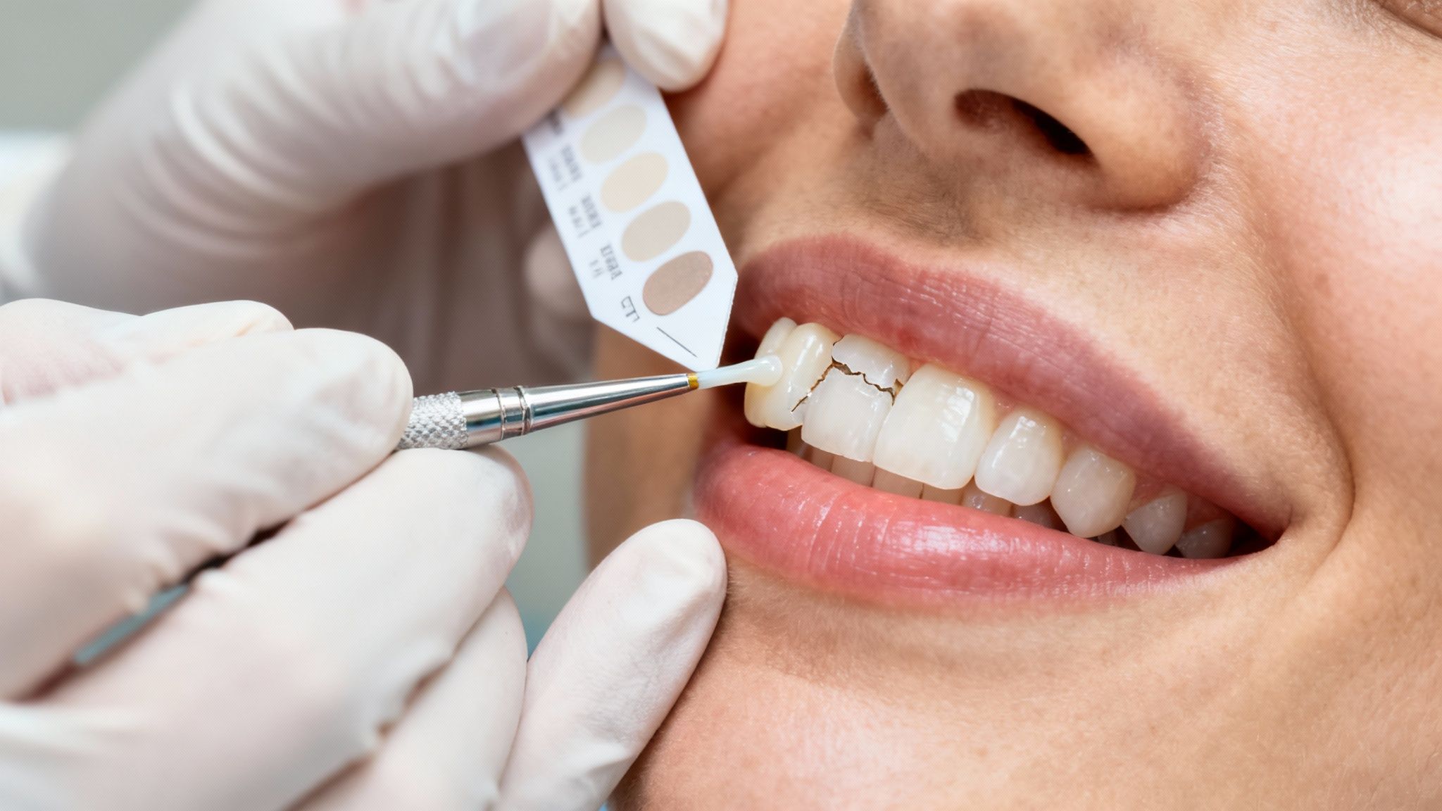 Dentist matching tooth shade with a guide for cosmetic dental repair on a cracked tooth.