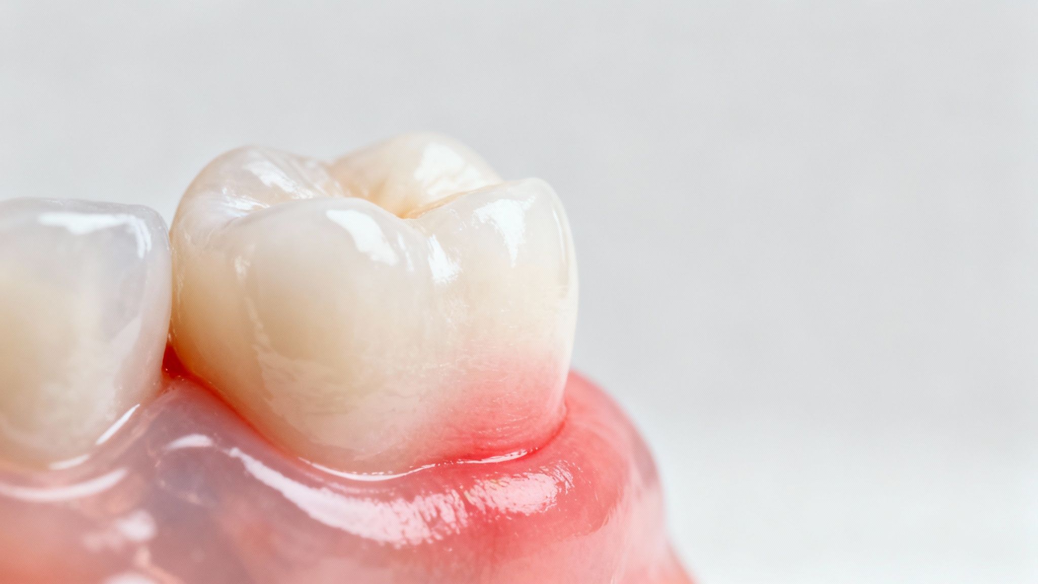 Bleeding Gums During Brushing or Flossing