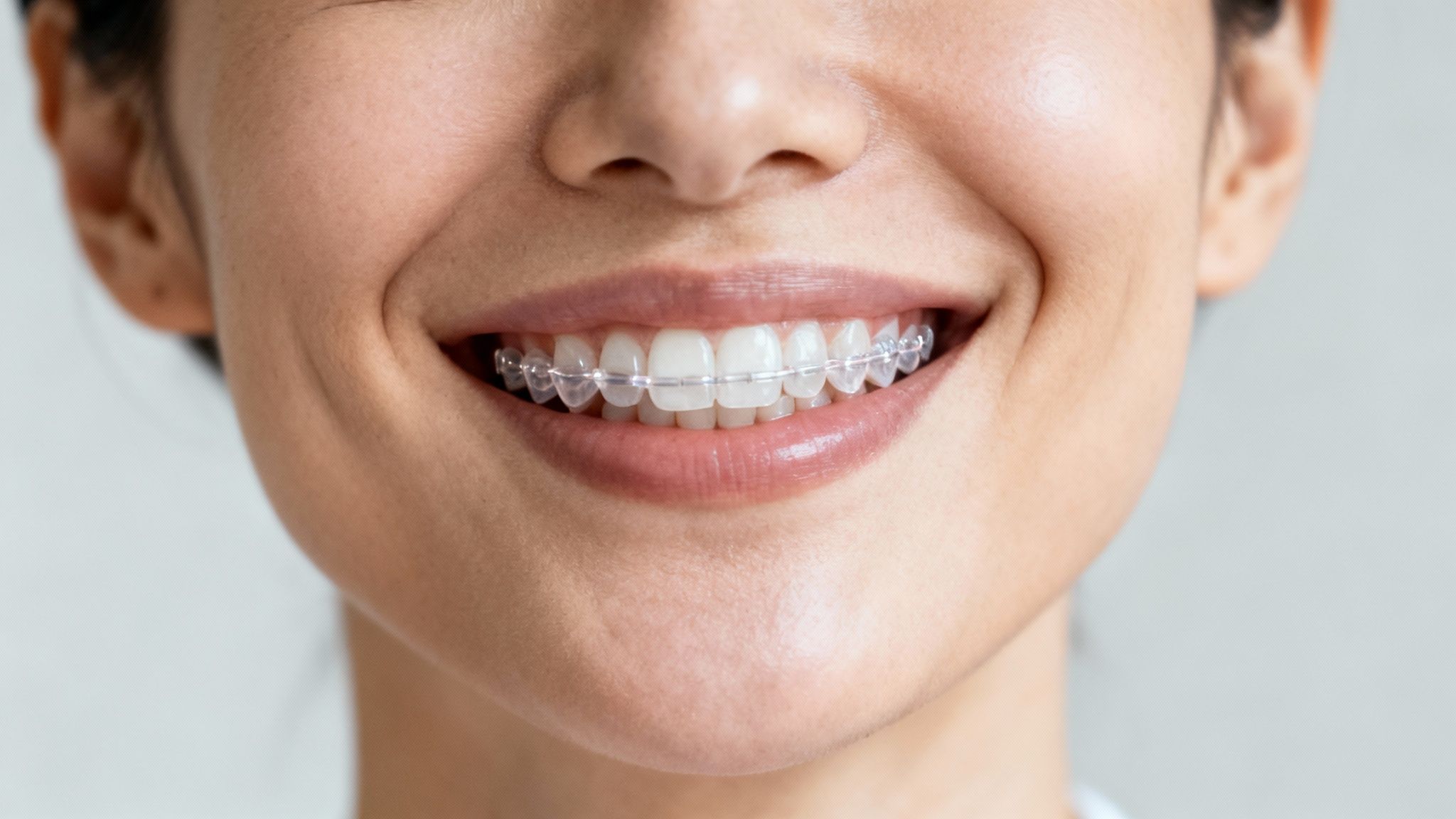Close-up of a smiling person showcasing clear ceramic braces on their teeth for orthodontic treatment.