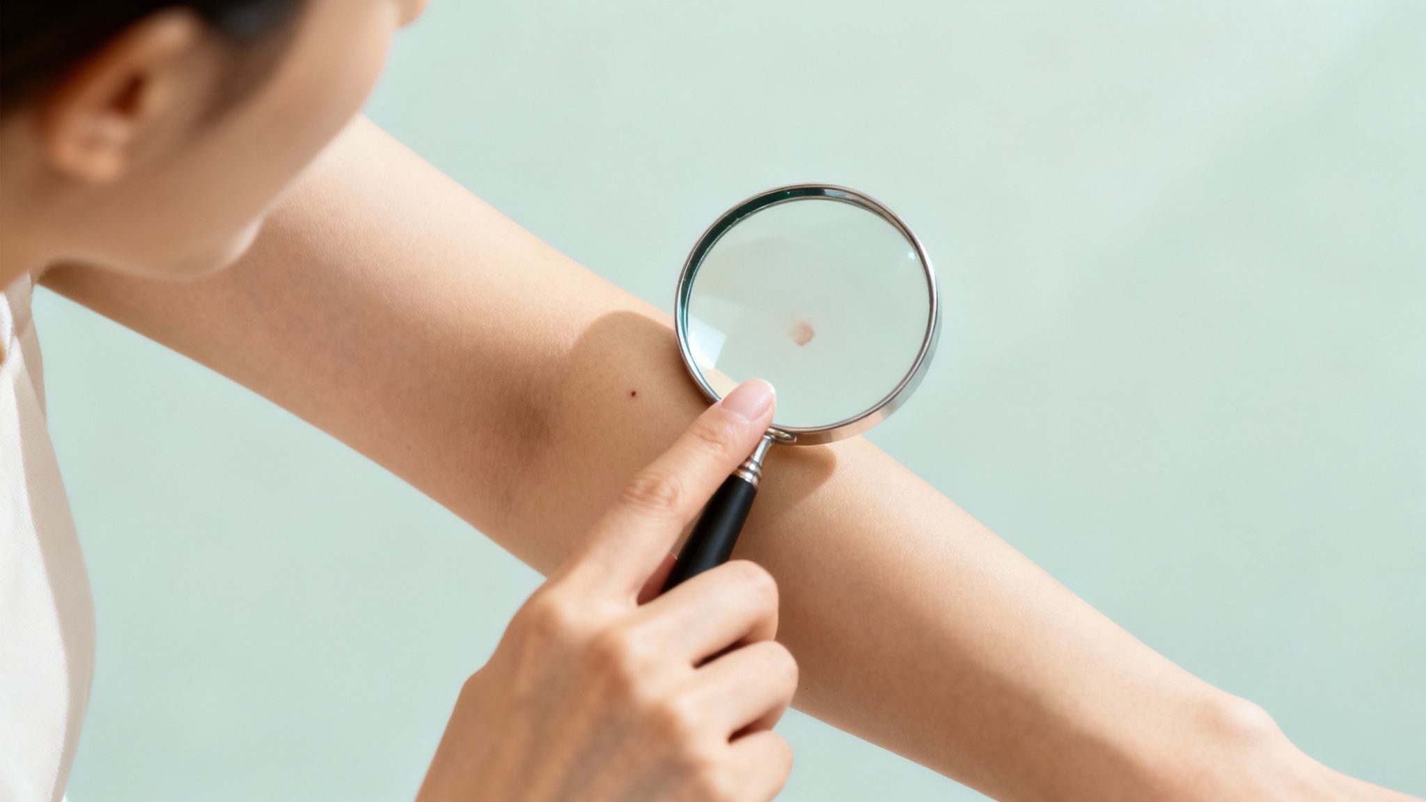 A Guide to Skin Checks for Melanoma