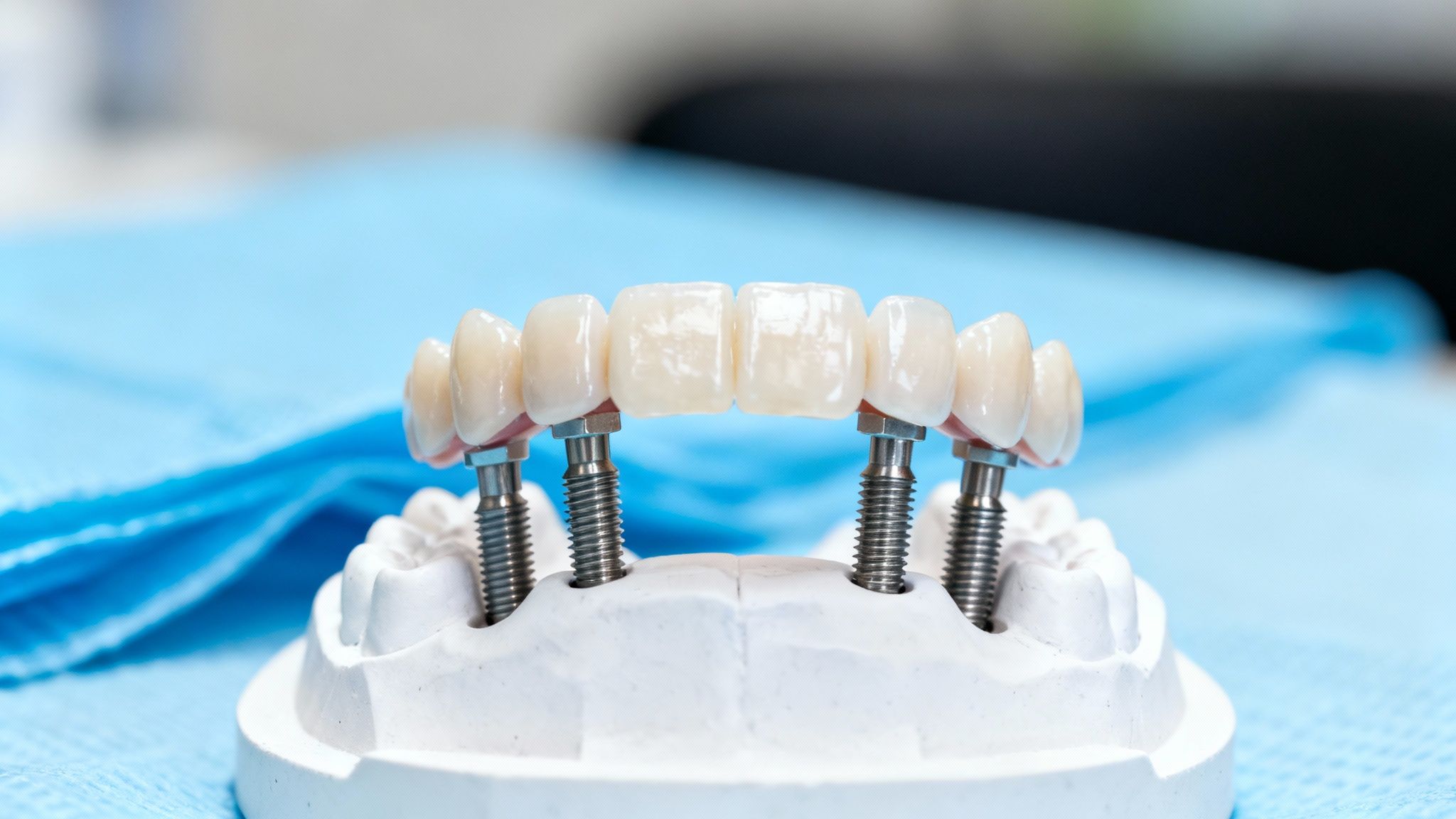 Close-up of a dental model showing the All-on-4 implant placement.