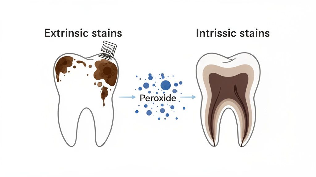 Diagram illustrates extrinsic teeth stains removed by brushing, and intrinsic stains treated with peroxide.