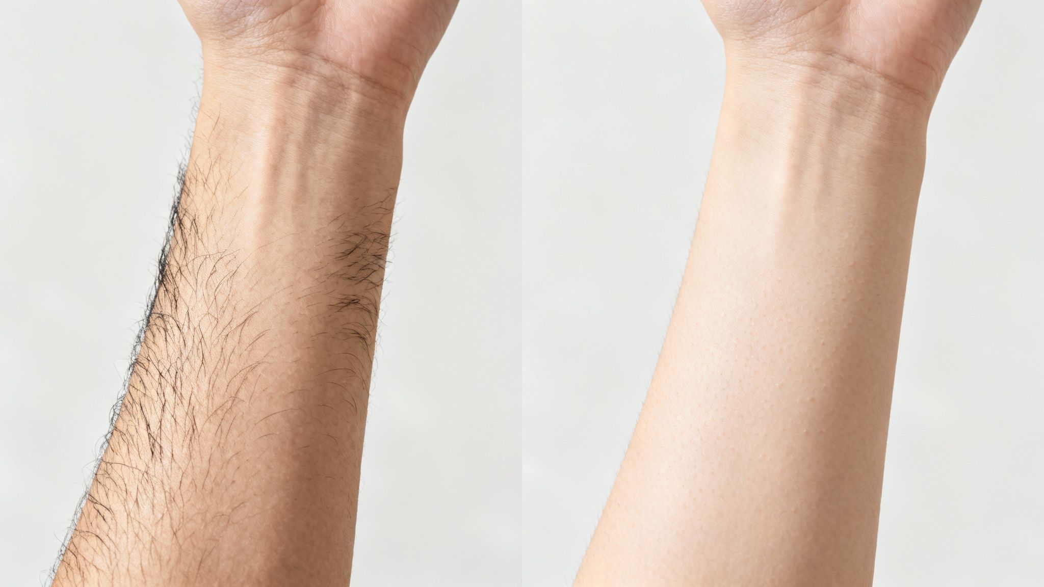 Ghid complet despre aparat laser epilare definitiva pentru o piele netedă 2 Două brațe, unul cu păr des și celălalt epilat, demonstrând rezultatele epilării definitive cu laser.
