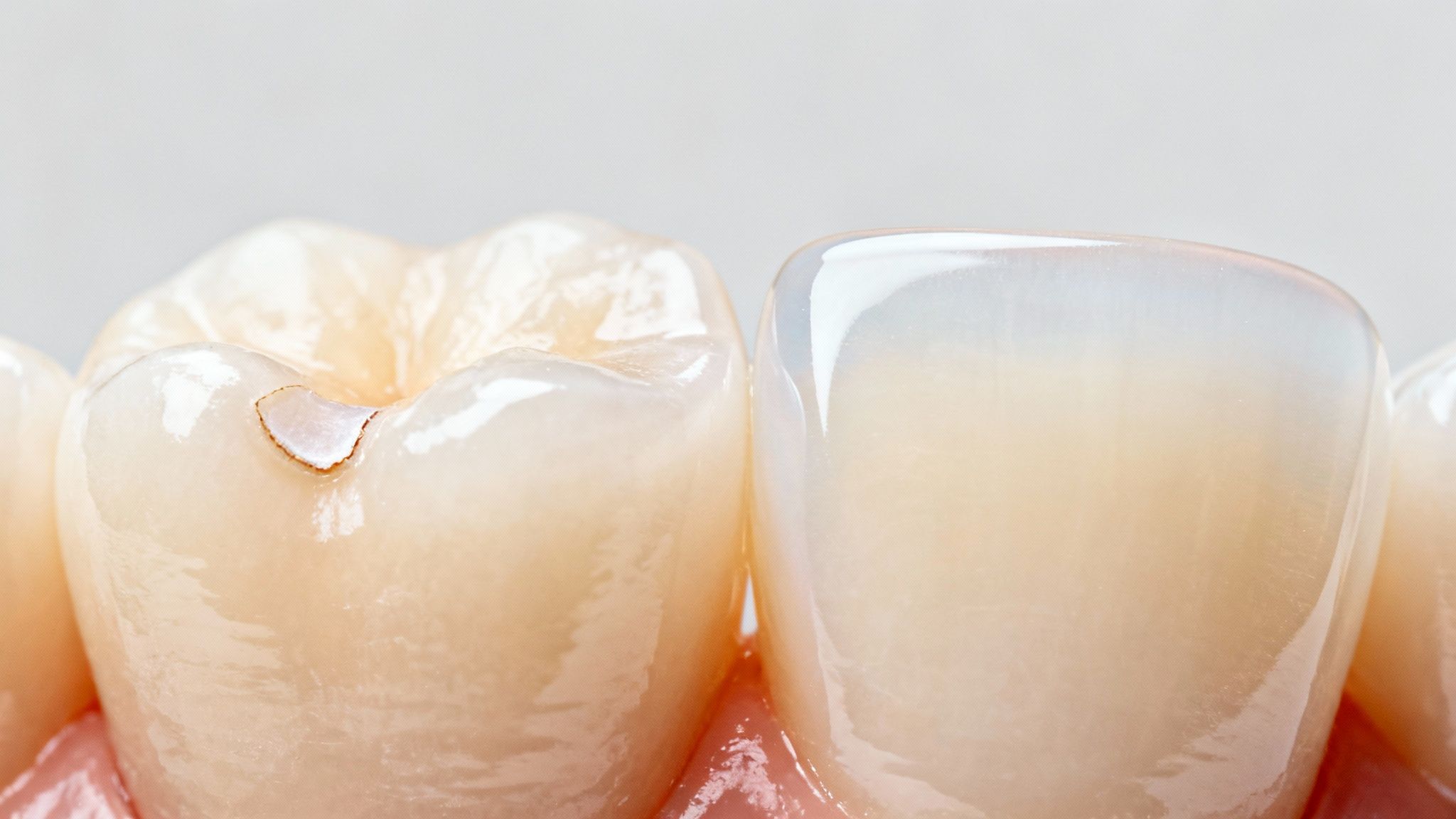A smiling woman showing off her perfect white teeth after a cosmetic dental procedure.