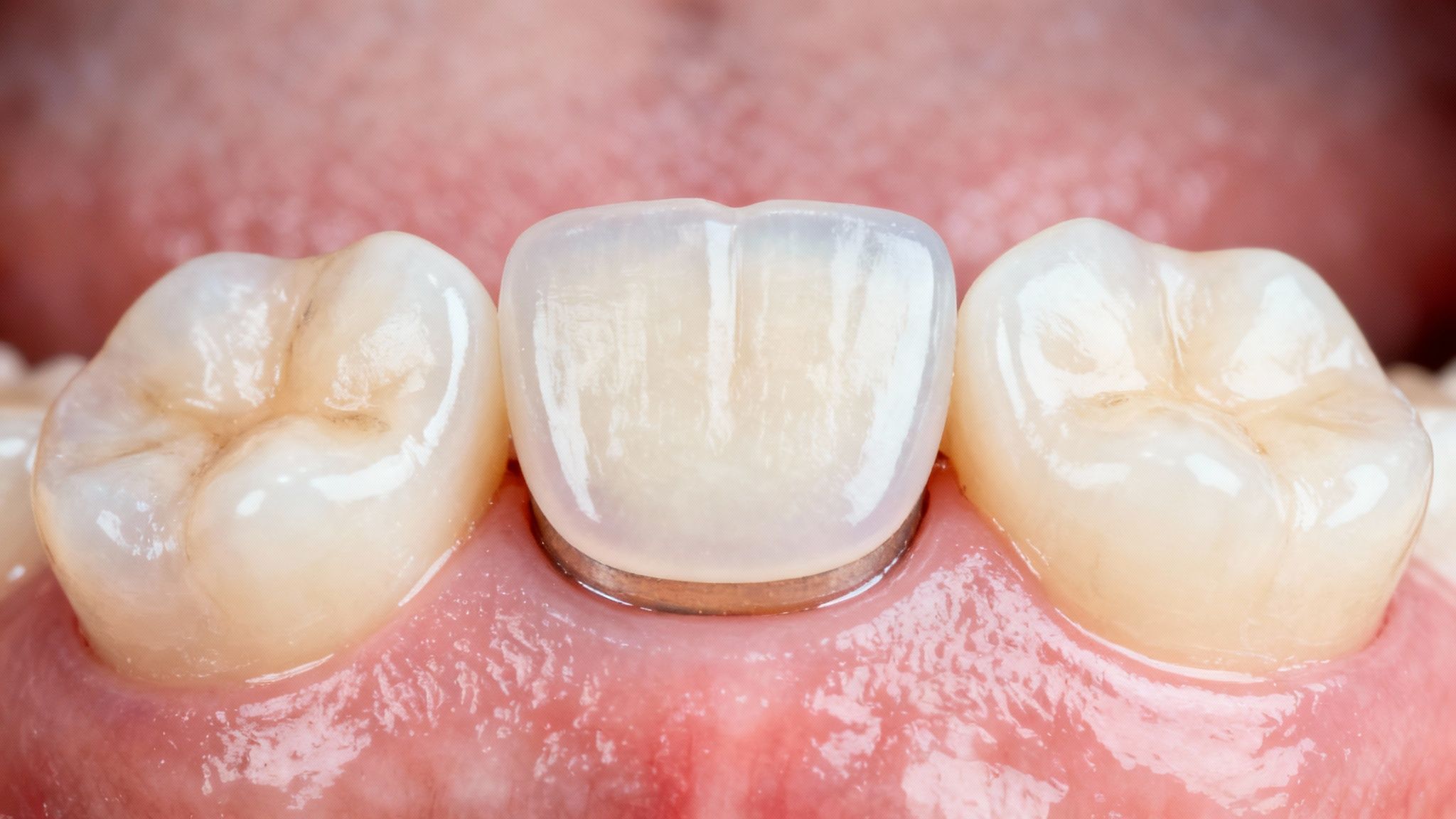 A dental bridge showing two crowns on either side of a prosthetic tooth.