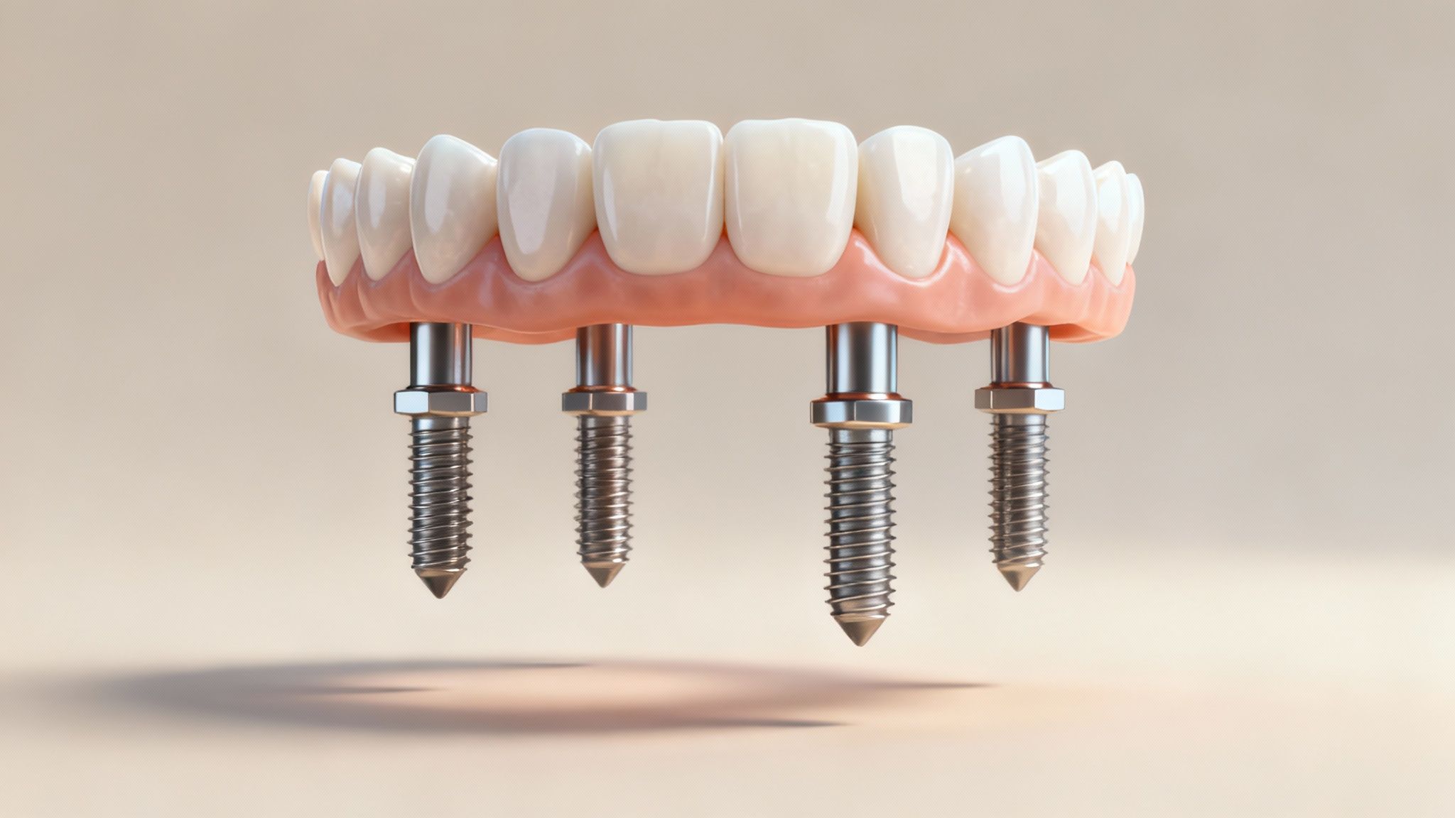 A diagram showing the All on 4 dental implant technique.