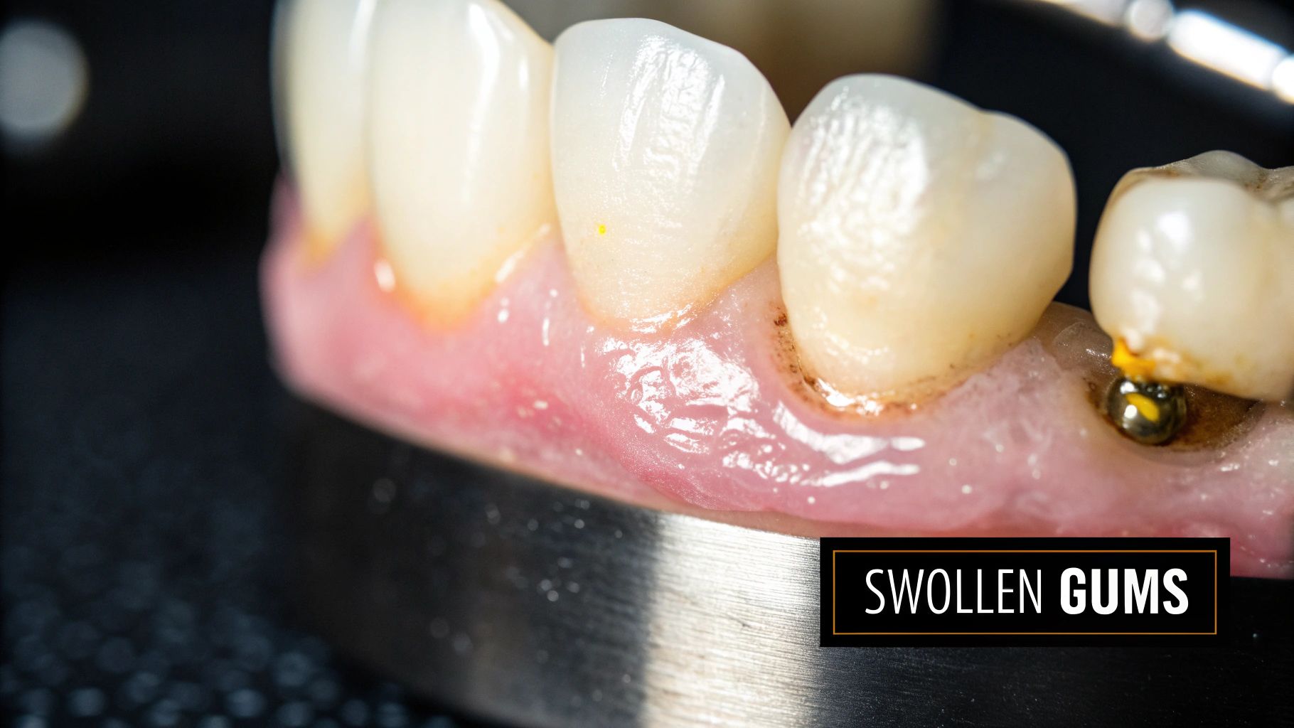 Swelling and Inflammation Around the Implant Site