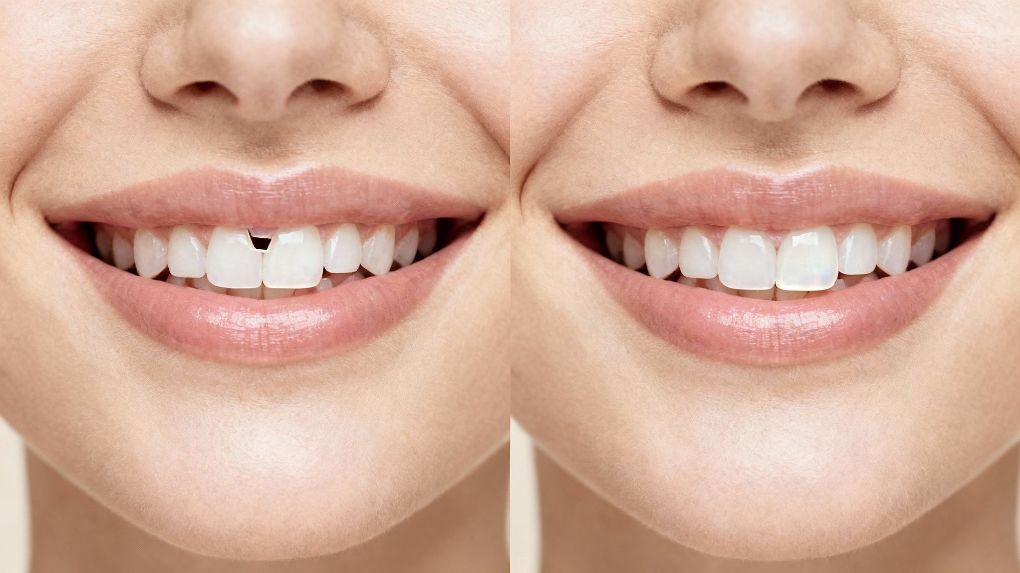Before and after close-up of a woman's smile, showing a corrected gap between front teeth.
