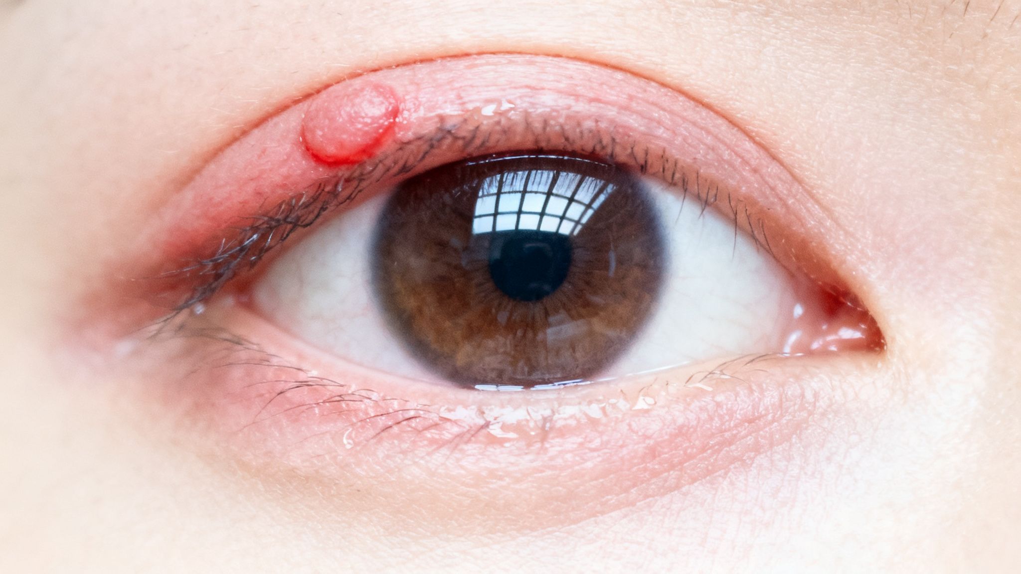 Primer plano de un ojo con un orzuelo rojo e inflamado en el párpado superior.