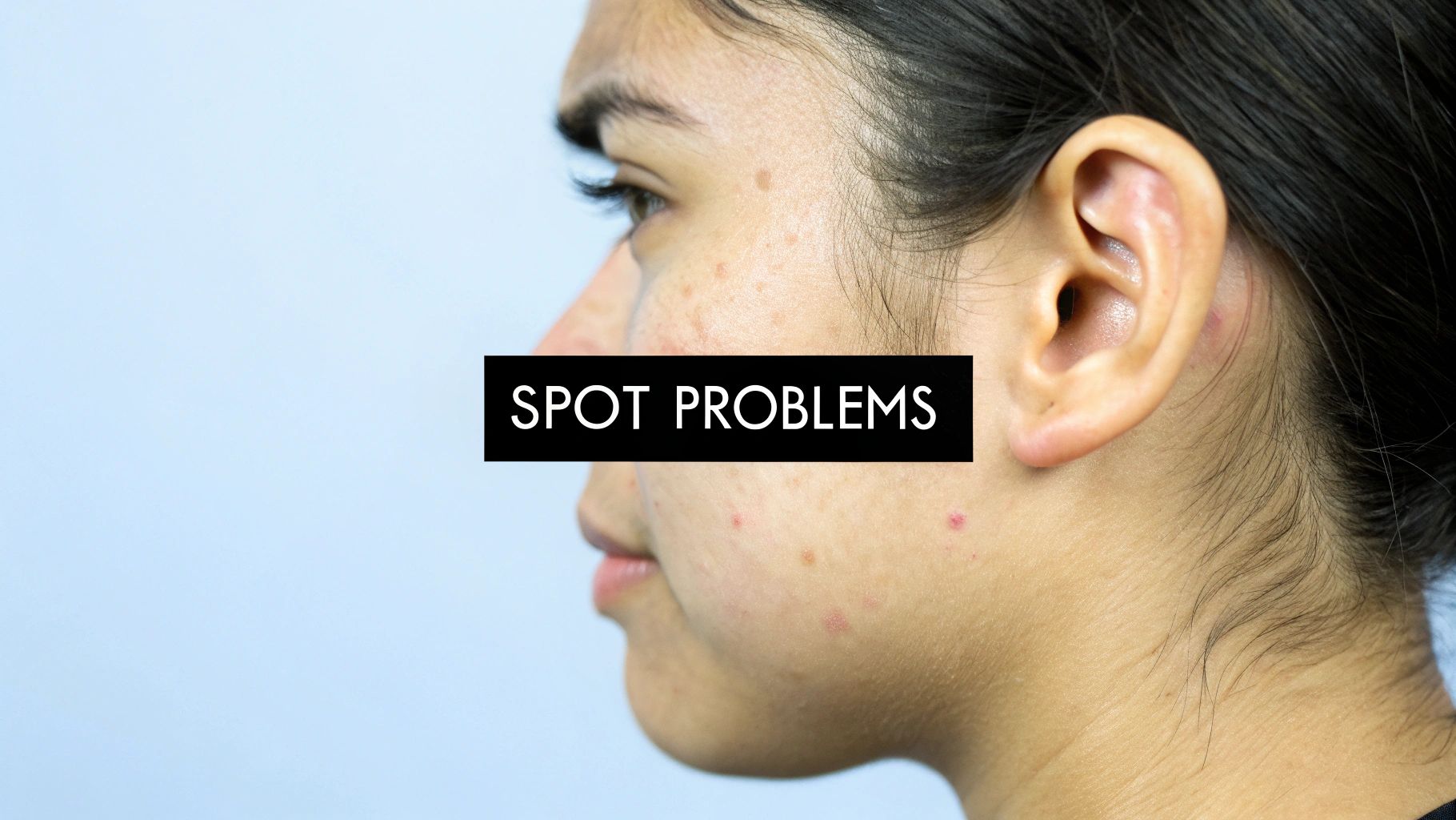 Side profile of a person with acne and red spots on their cheek and forehead, with the text 'SPOT PROBLEMS'.