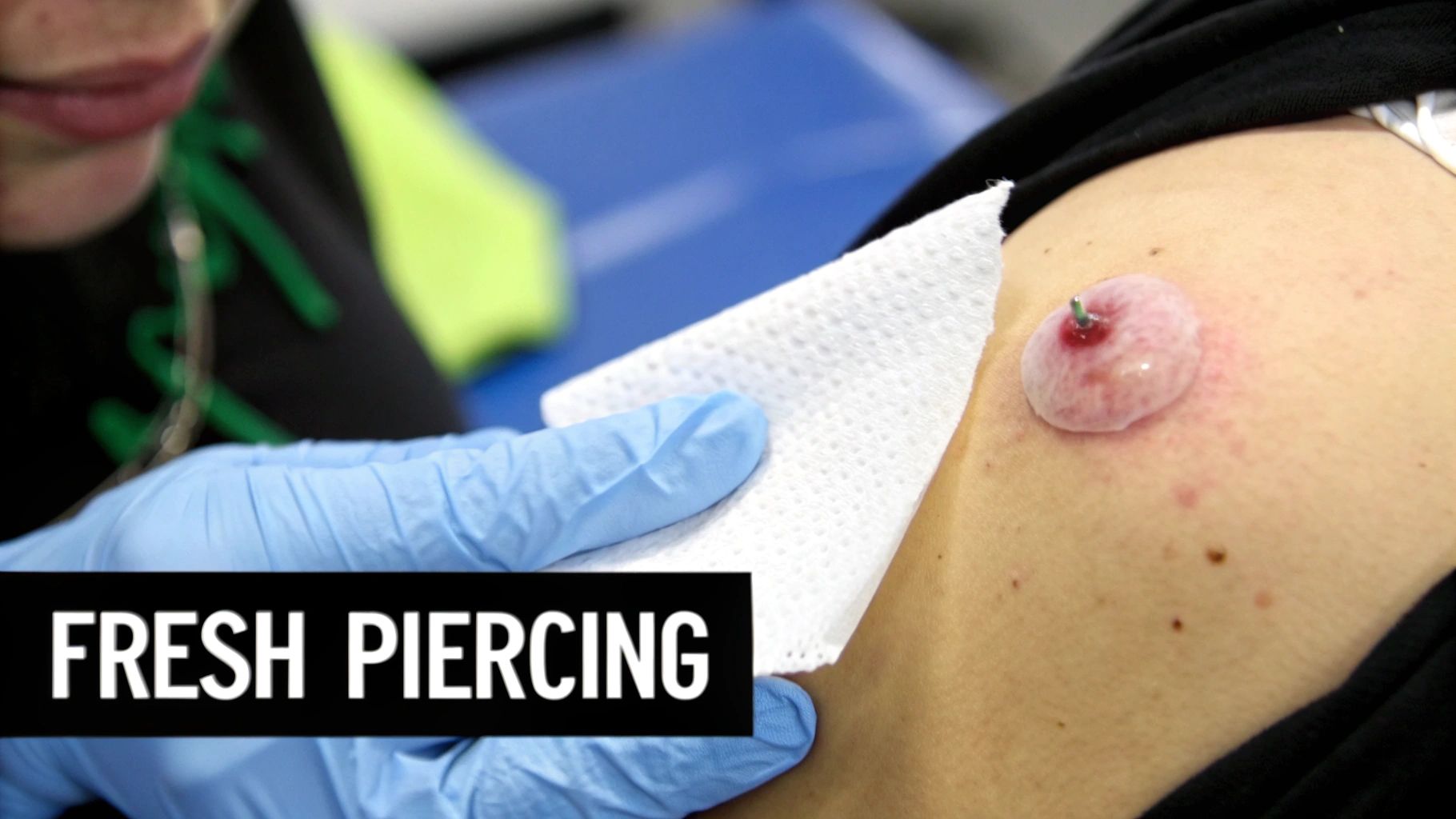 Close-up of a fresh skin piercing on a shoulder with a blister and redness, being cleaned by a gloved hand.