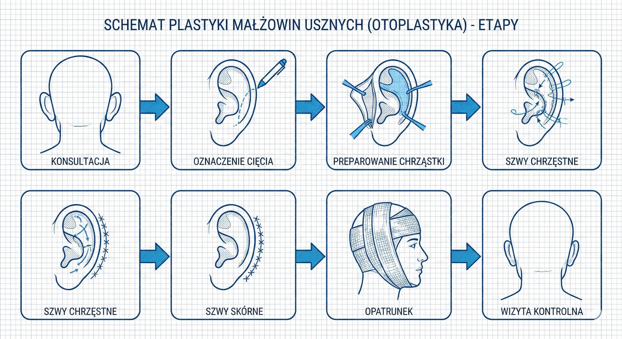 Schemat przedstawiający osiem etapów plastyki małżowin usznych (otoplastyki), od konsultacji po wizytę kontrolną.