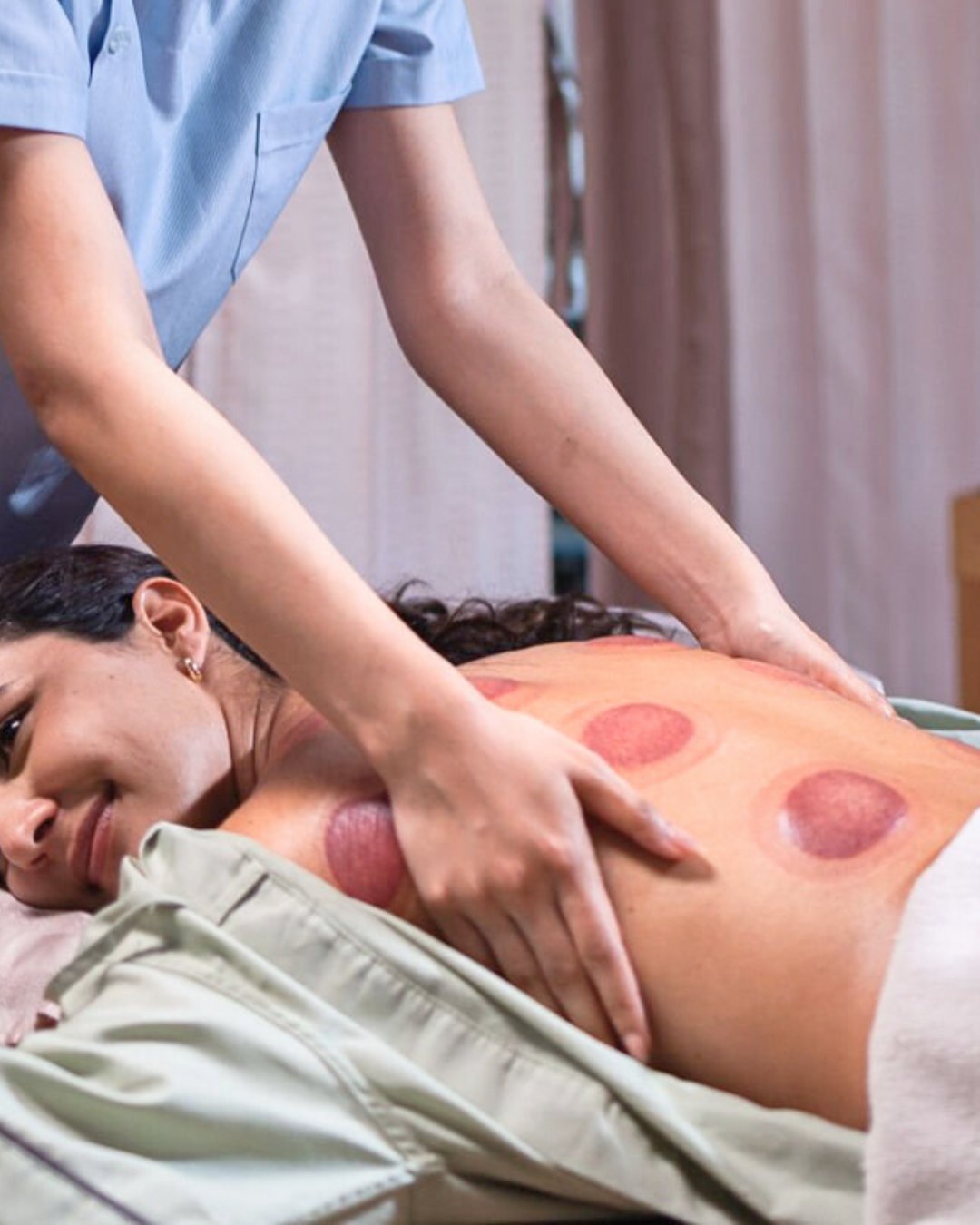 A person smiles while receiving cupping therapy on their back, administered by a therapist.