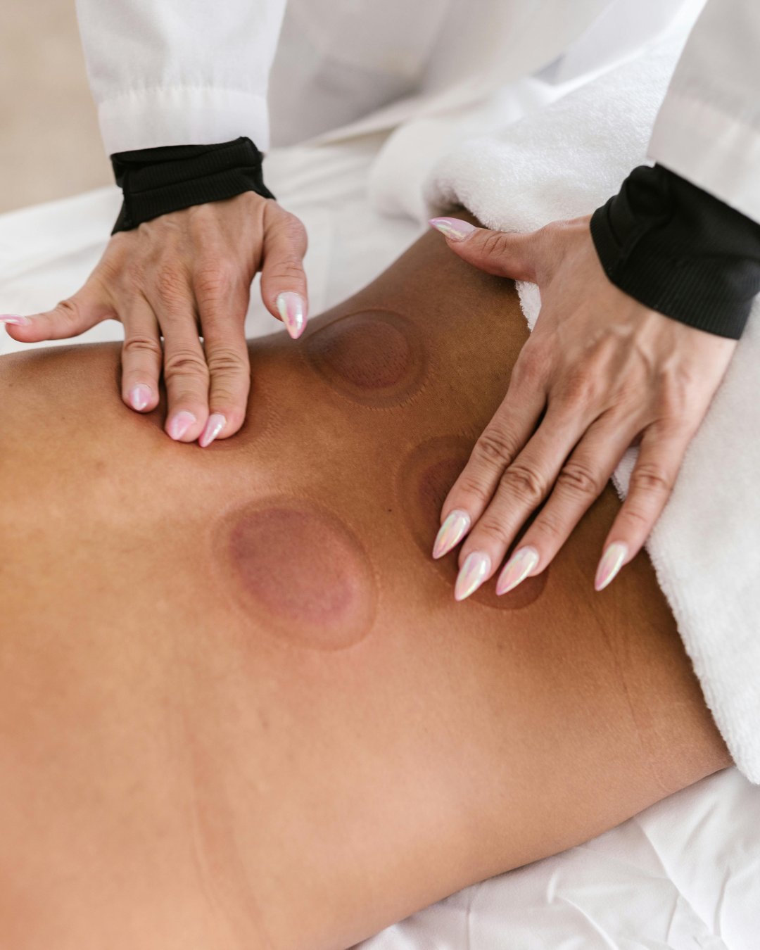 Close-up of a person receiving cupping therapy on their back, showing circular red marks and a practitioner's hands.