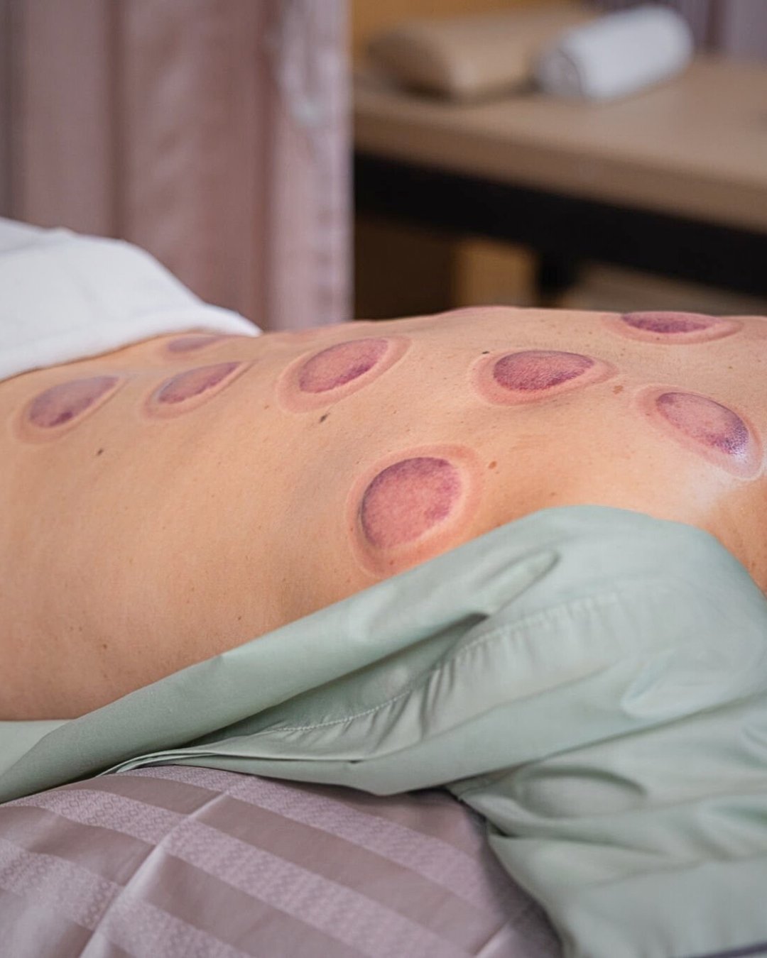 A person's bare back covered in circular, reddish cupping marks, lying on a treatment bed.