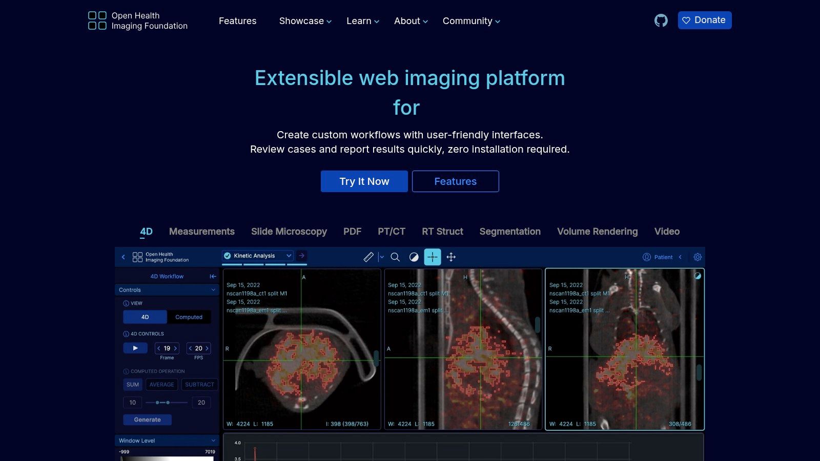 OHIF Viewer (Open Health Imaging Foundation)