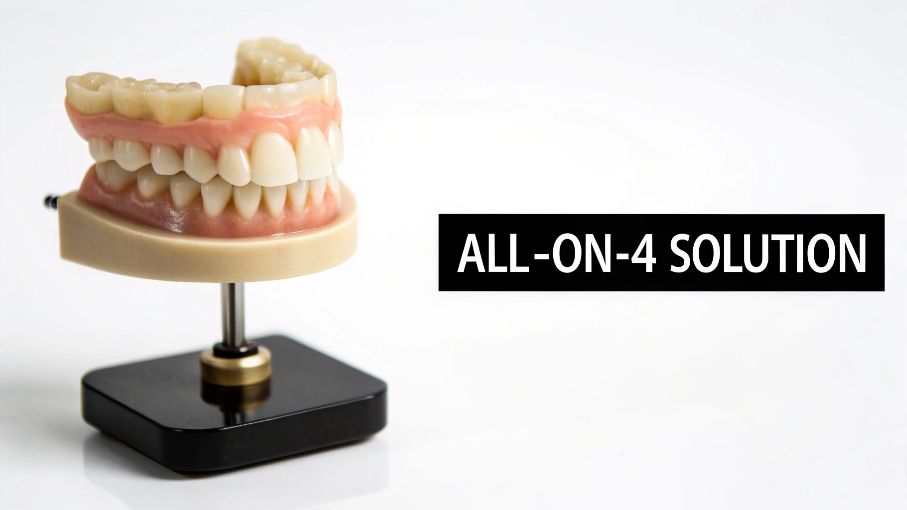 A detailed dental model illustrating an All-on-4 implant solution for full arch restoration.