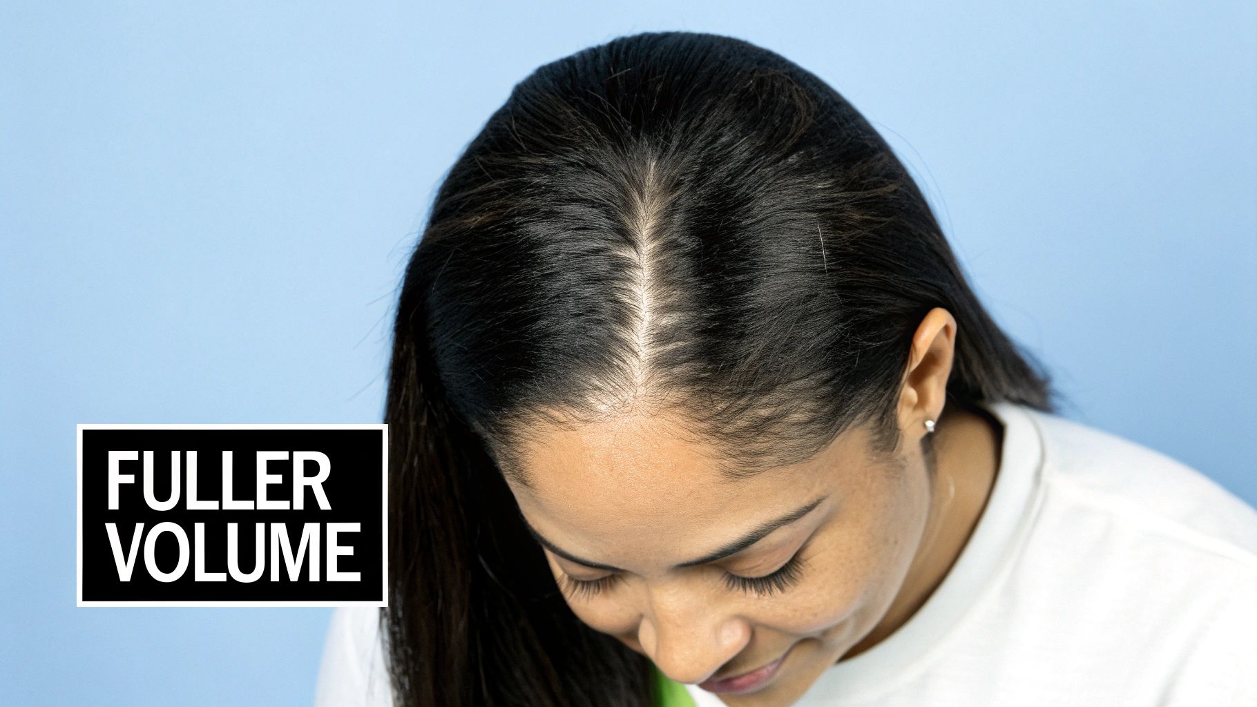 Female Pattern Hair Loss PRP Recovery