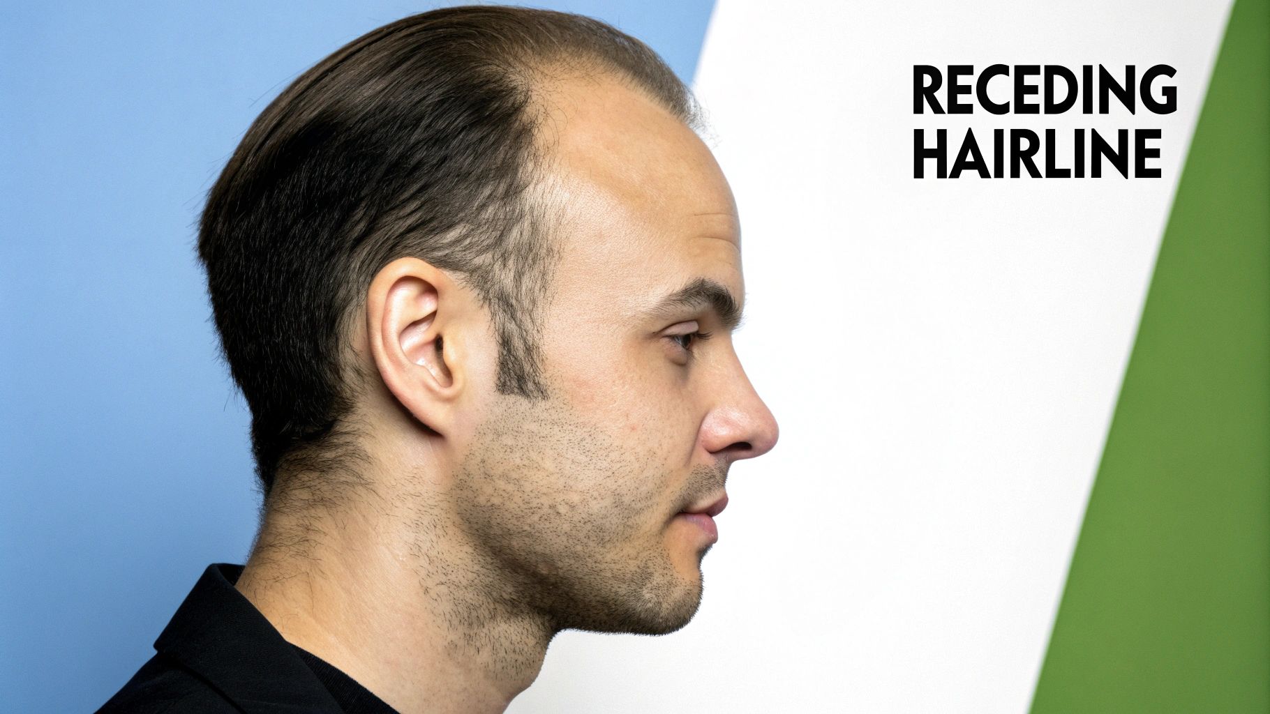 Receding Hairline