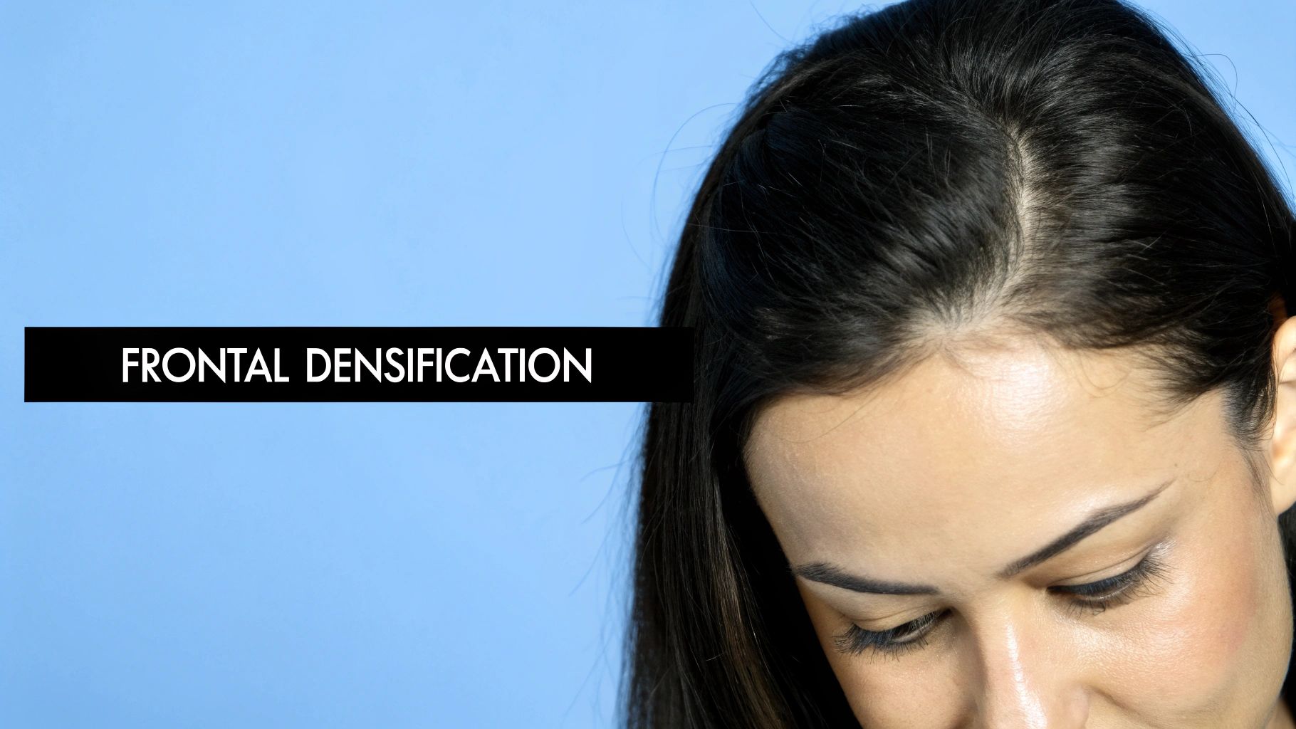 Frontal Hairline Densification