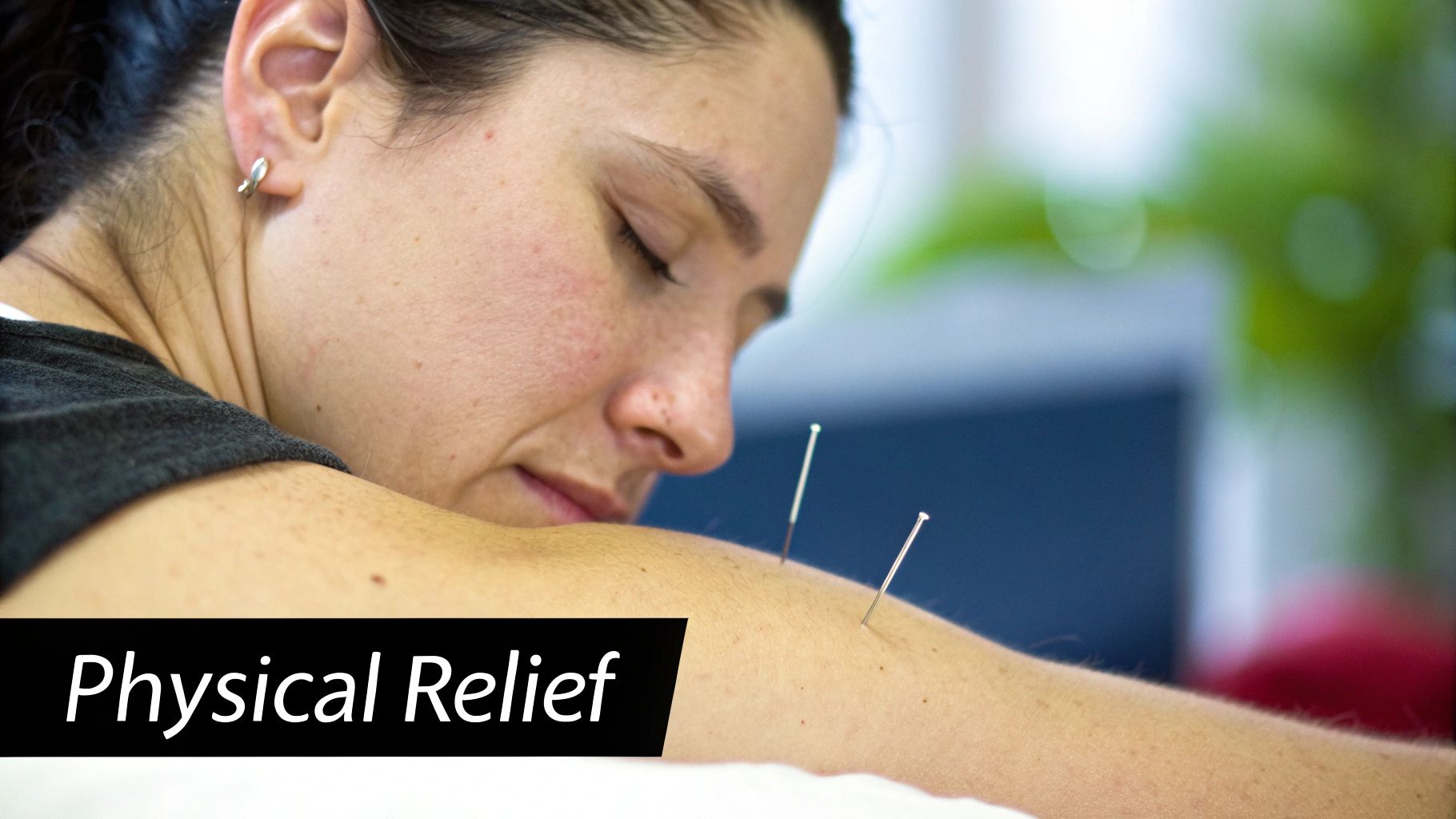 Acupuncture needles in a patient's back to relieve muscle tension.