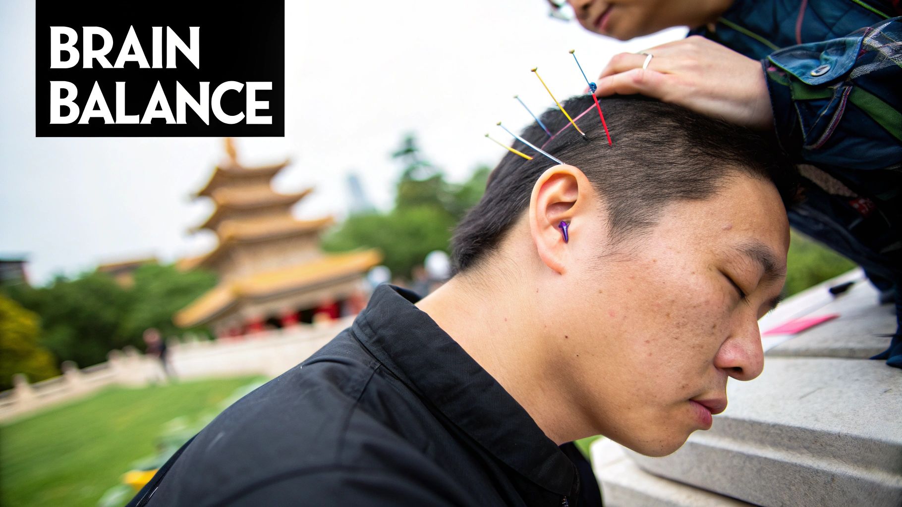 How Does Acupuncture Help Anxiety A close-up of acupuncture needles being applied gently to a person's forehead.